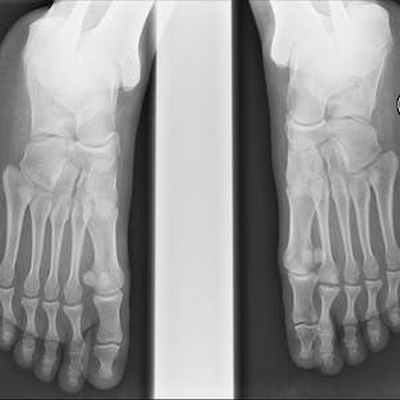 Осложнения болезни Фрейберга Avant pieds 3/4