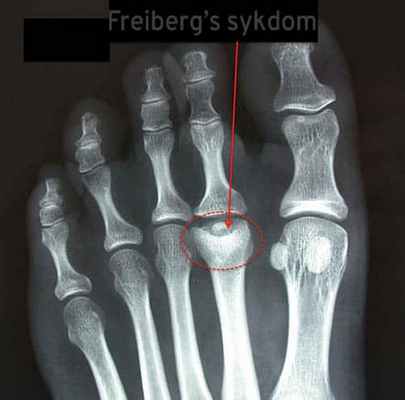 Рентген Фрейберга