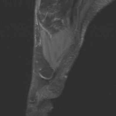 Осложнения болезни Фрейберга DP FS Sagittal