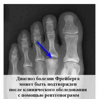 Рентген стопы при болезни Келлера