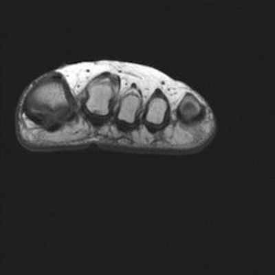 Осложнения болезни Фрейберга T1 Coronal