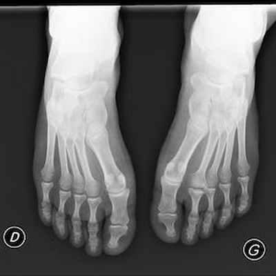 Осложнения болезни Фрейберга Avant pieds Face