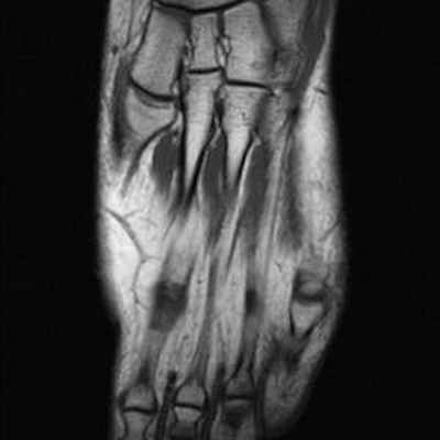 Осложнения болезни Фрейберга T1 Axial