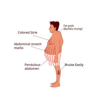 Синдром Иценко-Кушинга