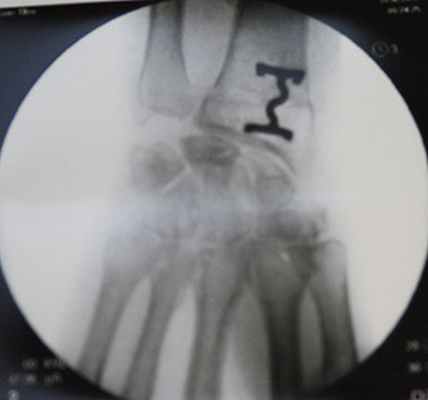 Снимок после укорочения лучевой кости