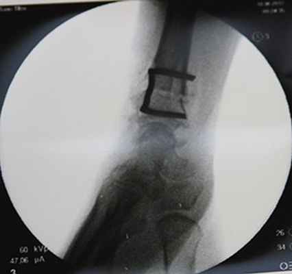 Элегантный способ фиксации остеотомии скобкой.