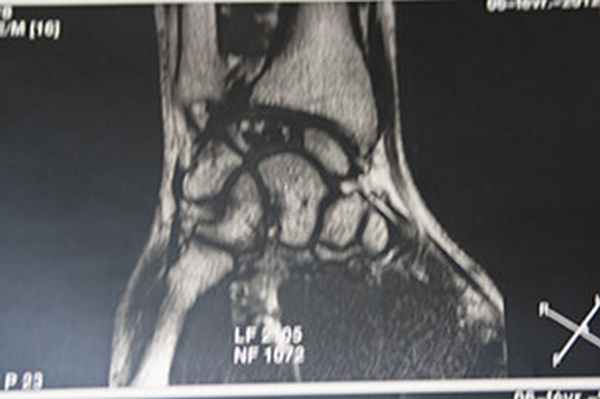 Некроз полулунной кости на МРТ