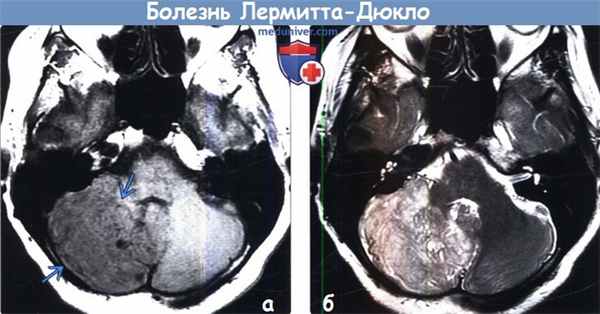 Болезнь Лермитта-Дюкло на МРТ