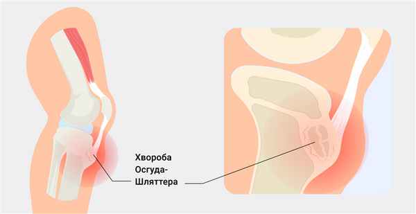 Лечение болезни Осгуда-Шляттера