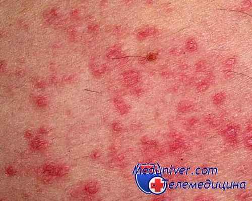 грудь с раком педжета