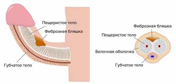 болезнь Пейрони