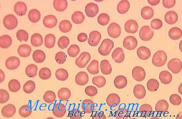 анемия у больной