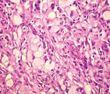 Случай болезни Розаи — Дорфмана у ребенка