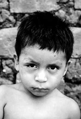 Острая стадия болезни Шагаса - виден отёк в районе правого глаза