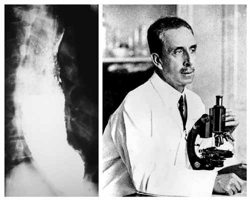 Слева - рентгенограмма пищевода при хронической болезни Шагаса. Справа - Карлос Шагас (Carlos Justiniano Ribeiro Chagas (1879-1934)