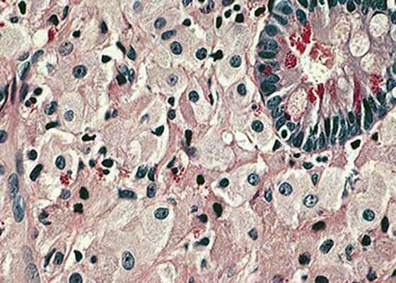 лечение болезни Уиппла