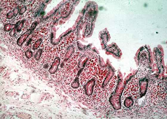 болезнь Уиппла