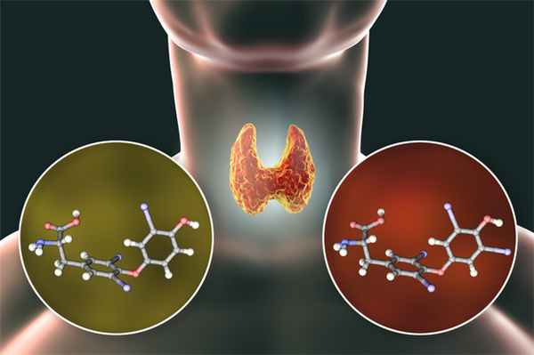 Лечение аутоиммунного тиреоидита Хашимото в Германии