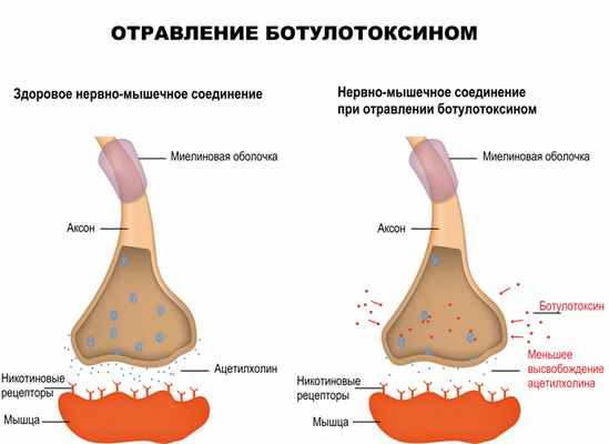Ботулотоксин и мышца.jpg
