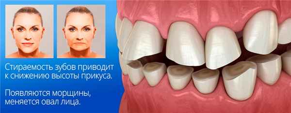 Снижение высоты прикуса меняет форму лица