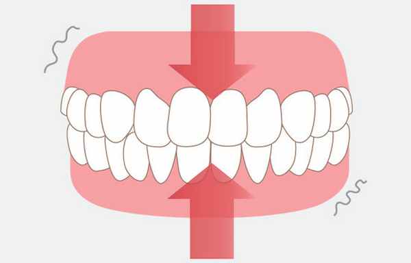 Тихий бруксизм