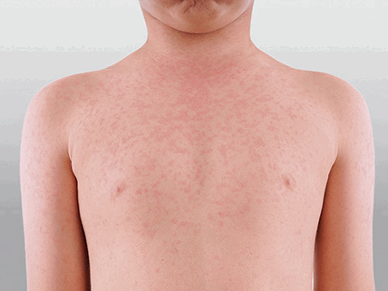 Брюшной тиф