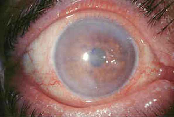 Буллезная кератопатия