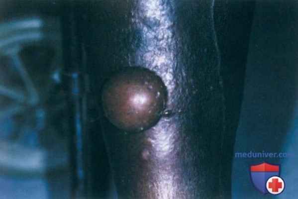 Буллезные высыпания