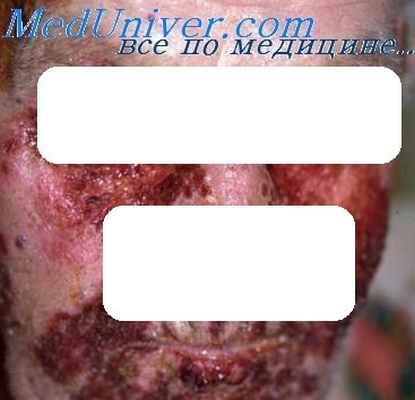 буллезный пемфигоид