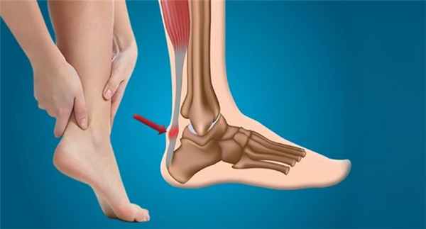 Ахиллово сухожилие - где находится