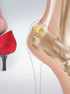 Фото Бурсит ахиллова сухожилия