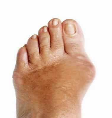 Фото Бурсит большого пальца стопы