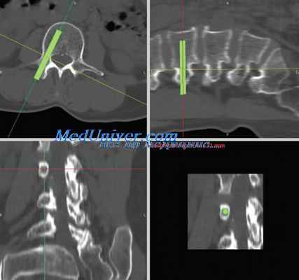 лапароскопическая дискэктомия