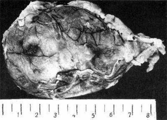 Макропрепарат целомической кисты перикарда того же больного