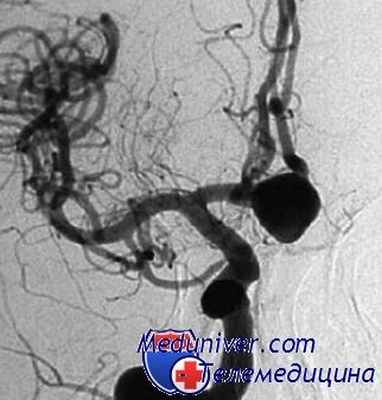 церебральная ангиография при субарахноидальном кровоизлиянии
