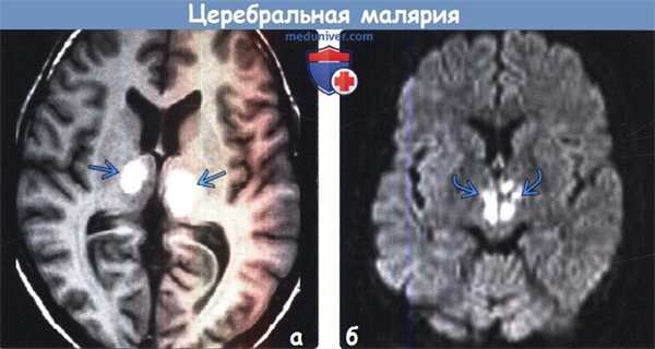 Церебральная малярия на МРТ