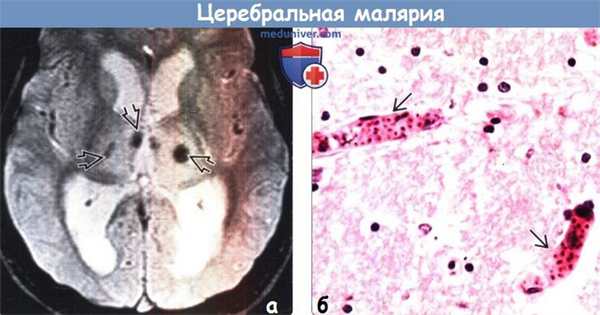 Церебральная малярия на МРТ