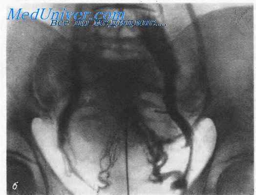 Чрезматочная флебография.