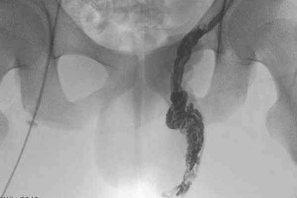 Флебография для мужчин