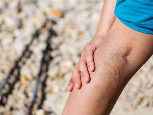 Как выполняется флебография – подготовка к исследованию и этапы выполнения