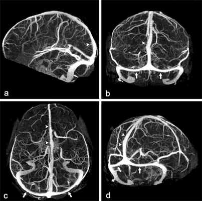 МР-флебография сосудов головного мозга