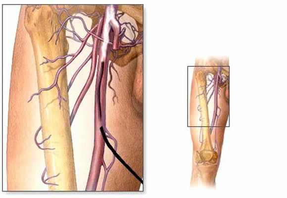 Флебография нижних конечностей