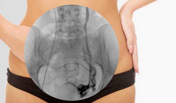 Флебография вен малого таза