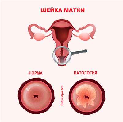 Шейка матки.jpg