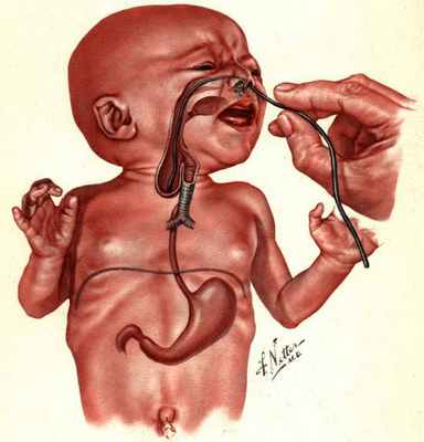 Назогастральный зонд, упирающийся в атрезию пищевода