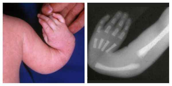 Дефекты лучевой кости