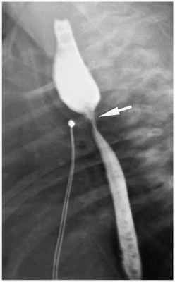 Стеноз пищевода
