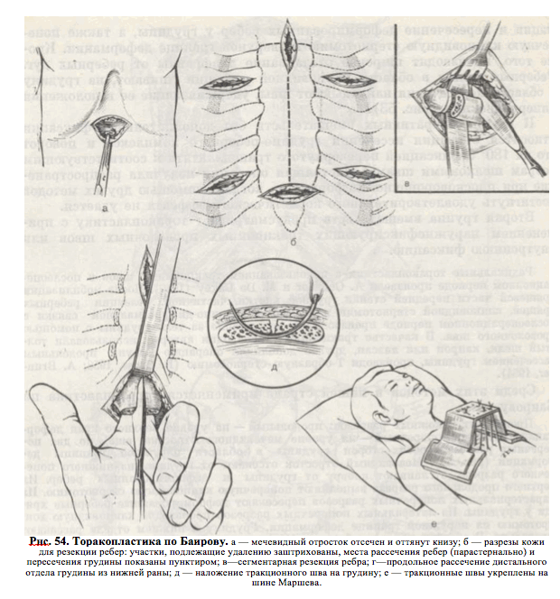 торакопластика по баирову