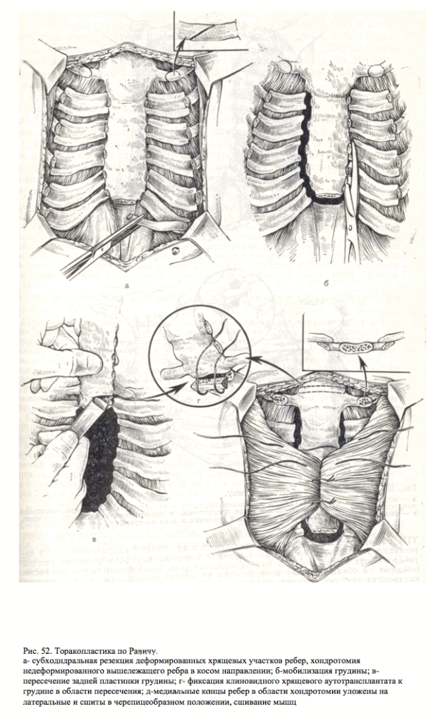 торакопластика по равичу