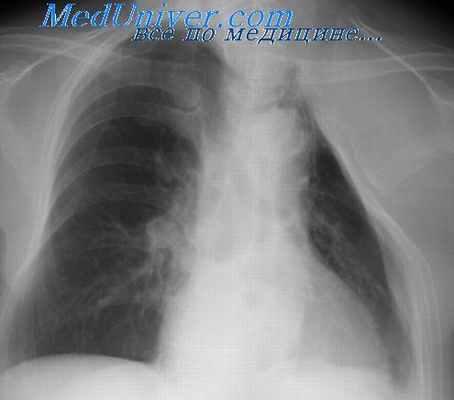 торакомиопластика